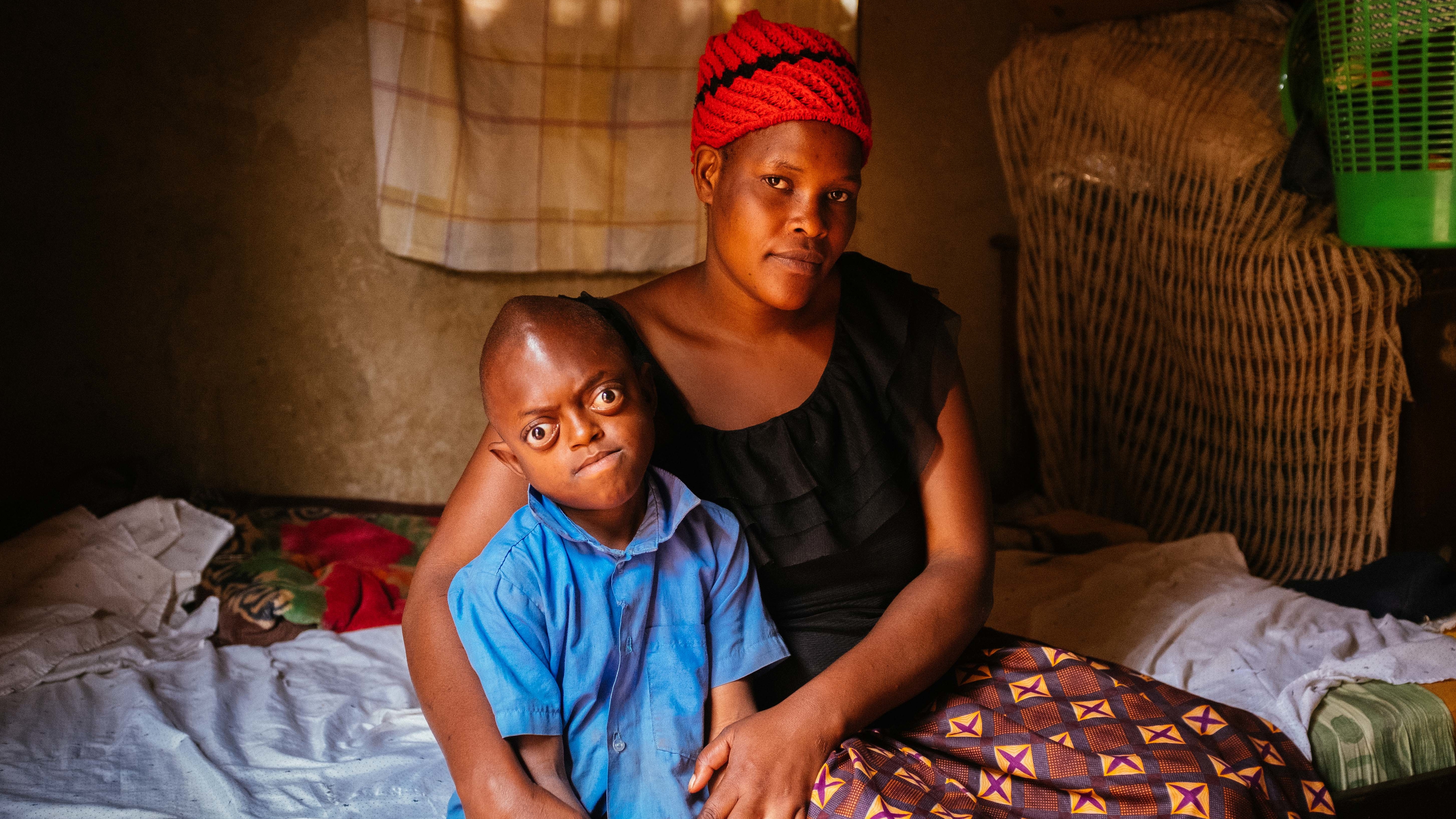 The Boy Whose Eye Falls Out